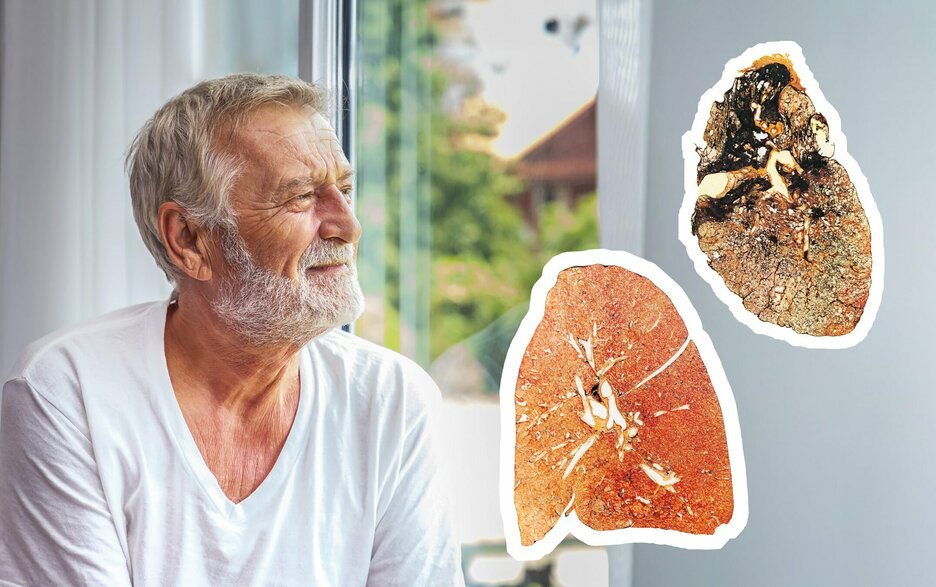 Das Bild zeigt einen älteren Mann mit grauen Haaren und Bart im Porträt, der nach rechts aus einem Fenster schaut. Er lächelt leicht. Rechts neben ihm sind zwei Abbildungen eingeklinkt, die Querschnitte einer Lunge zeigen. Eine zeigt eine gesunde Lunge, die rötlich und stark aussieht, die andere eine sogenannte „Staublunge“, die schwarz-braun und kränklich aussieht. Link zum Artikel.